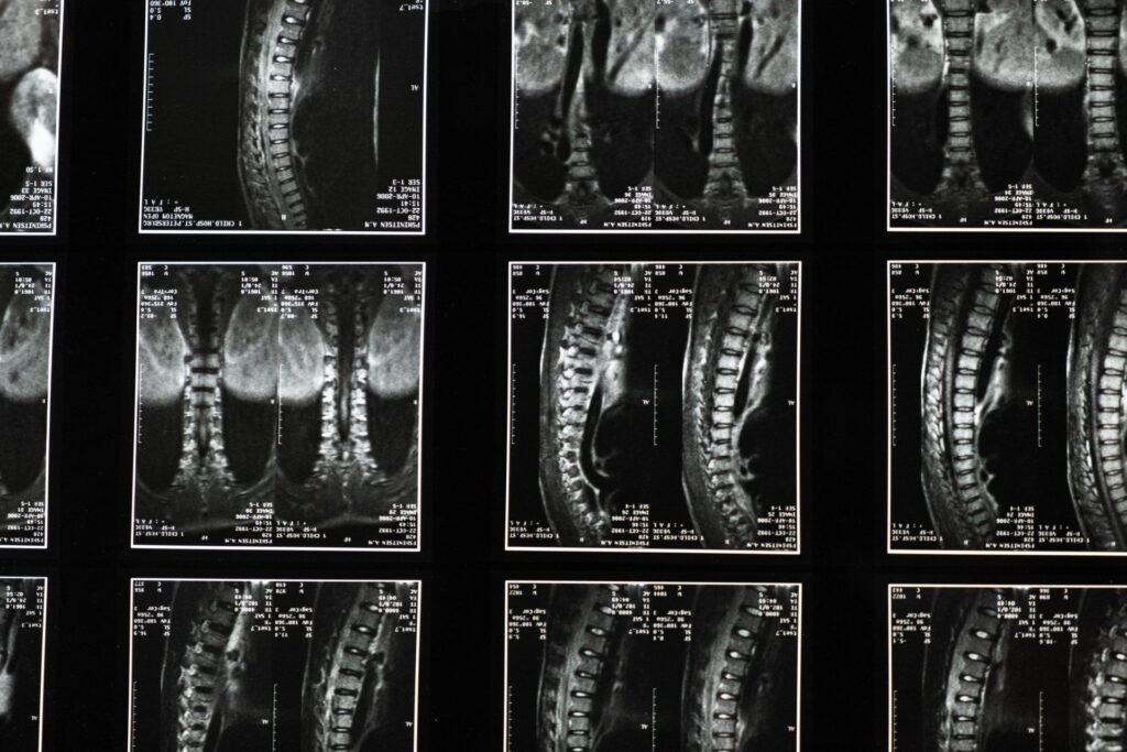 spine mri