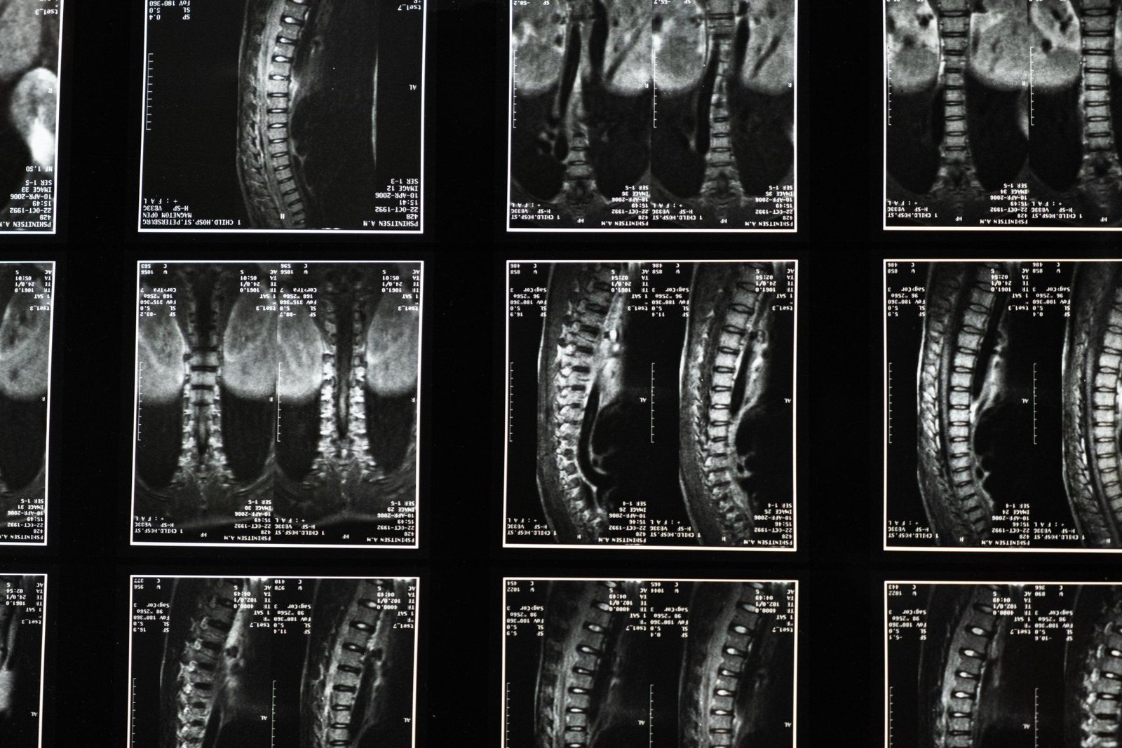 spine mri